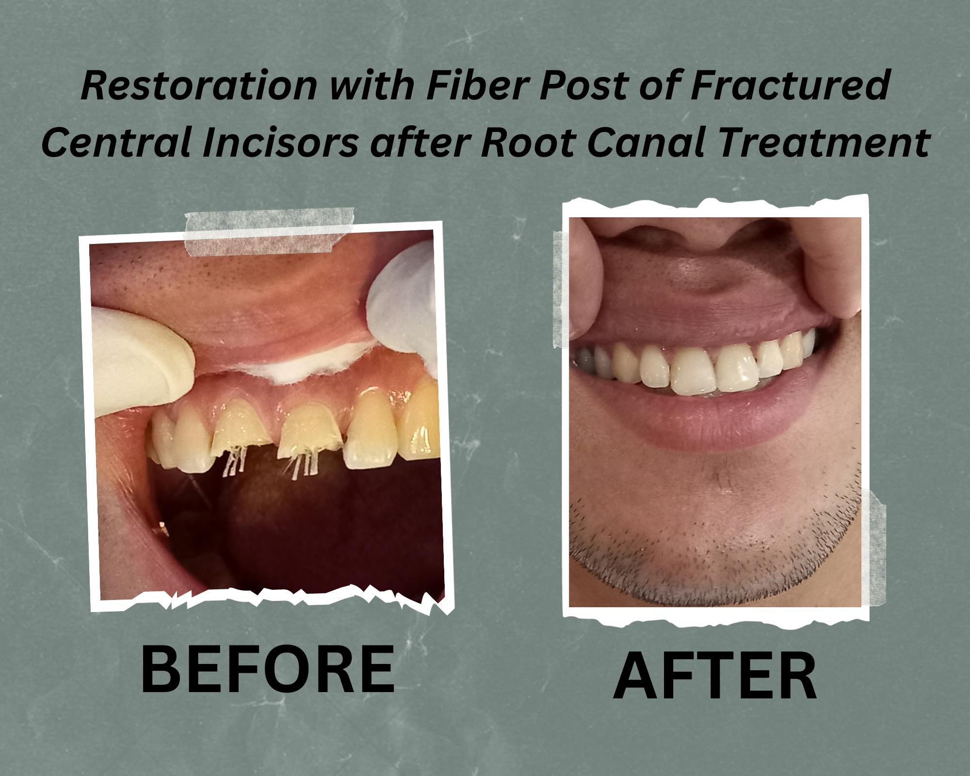 Fiber Post Treatment
